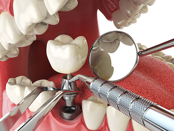 Best Emergency Root Canal Treatment in Germantown, TN